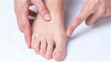 bunion gait retraining