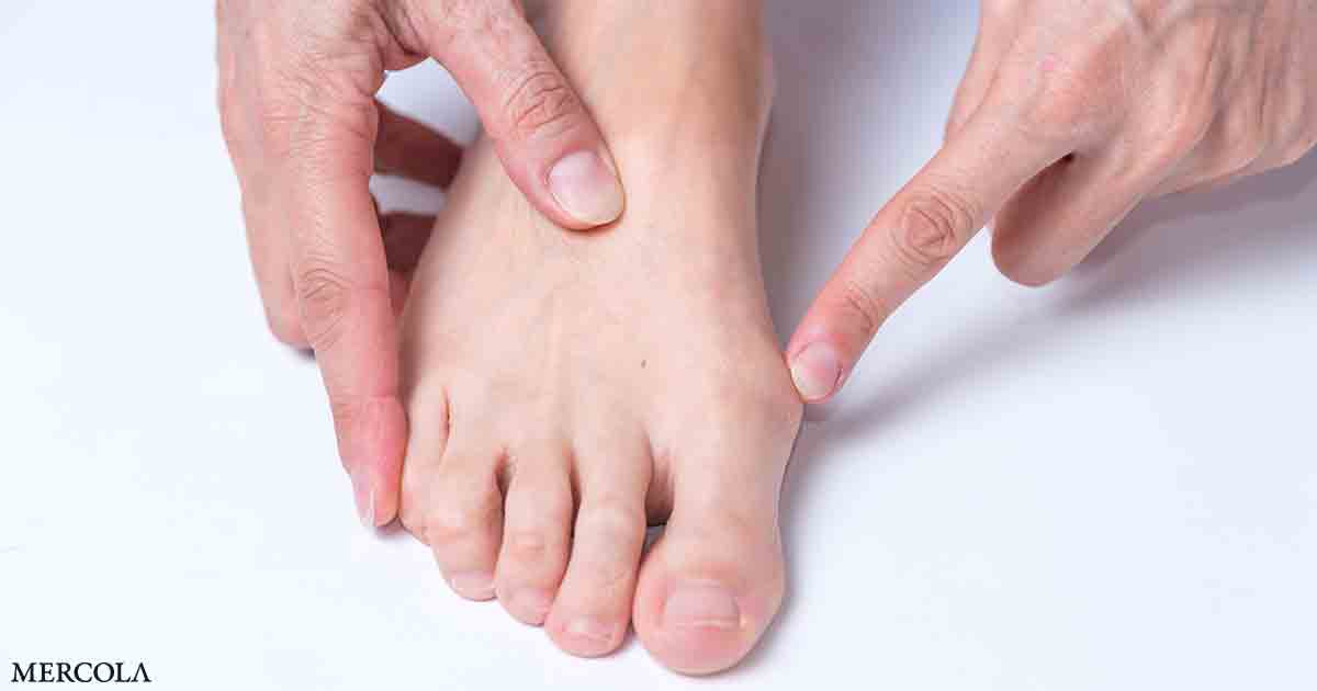 Reversing the Cause of Bunions Through Gait Retraining