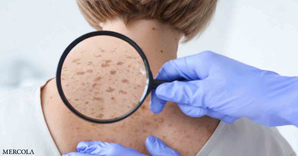 What Is the Difference Between Sunspots and Skin Cancer?