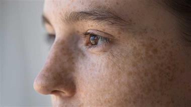 difference between freckles sunspots moles