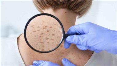 difference between sunspots and skin cancer
