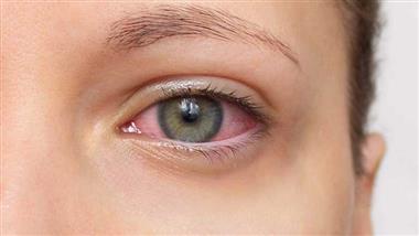 dry eyes treatment