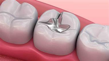 dental silver mercury fillings