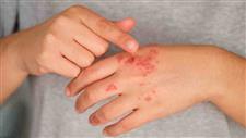 progesterone dhea psoriasis