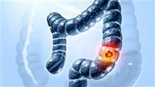 Ultraprocessed Foods Linked to Early Onset of Colorectal Cancer