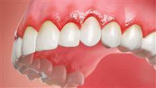 gum disease systemic inflammation diabetes