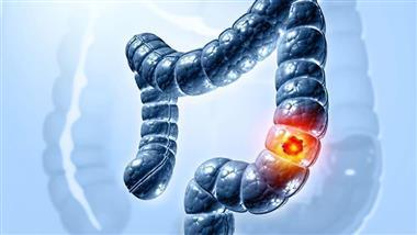 Ultraprocessed Foods Linked to Early Onset of Colorectal Cancer