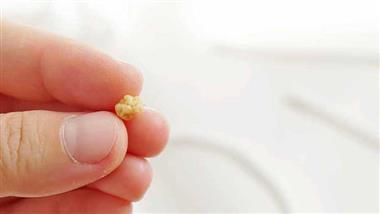 how to prevent tonsil stones from coming back