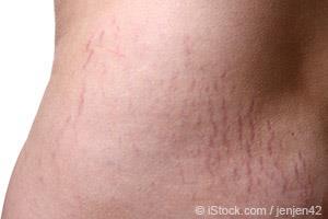 Teenager With Stretch Markss