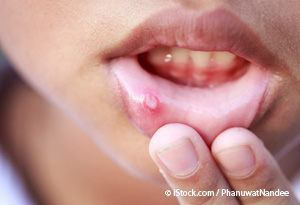 Sore Throat? Find Out if It’s a Cold, Strep Throat, or ...