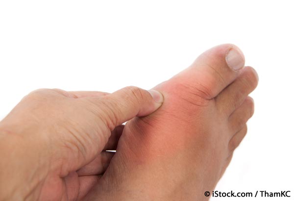 how to prevent gout