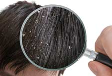dandruff or dry scalp