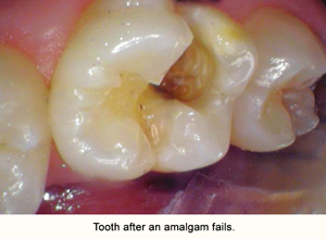 toothafteramalgamfails