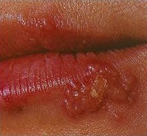 Vesículas de herpes oral