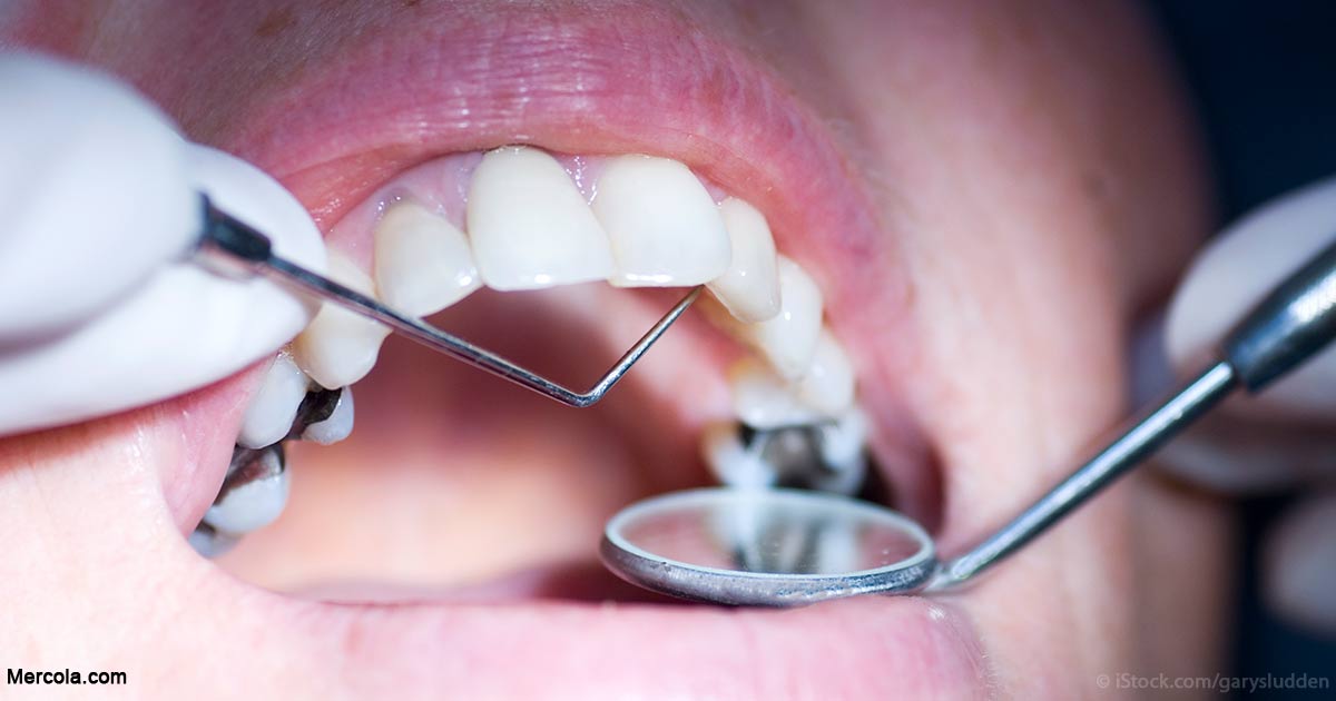 RÃ©sultat de recherche d'images pour "amalgames dentaires"
