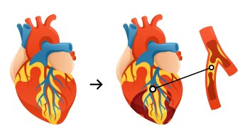 Cholesterol i serce