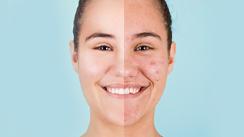remèdes maison contre l’acné