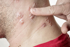 Shingles Infection